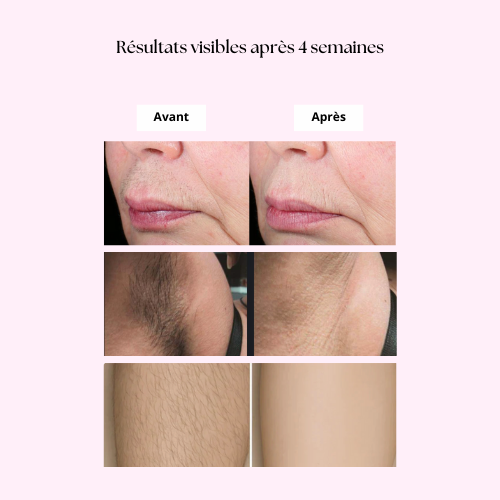 Épilateur IPL Premium Lumipro